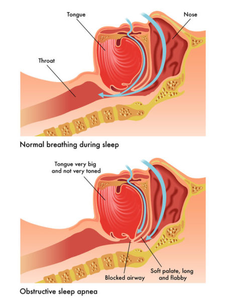 40700073 - obstructive sleep apnea 40700073 - obstructive sleep apnea