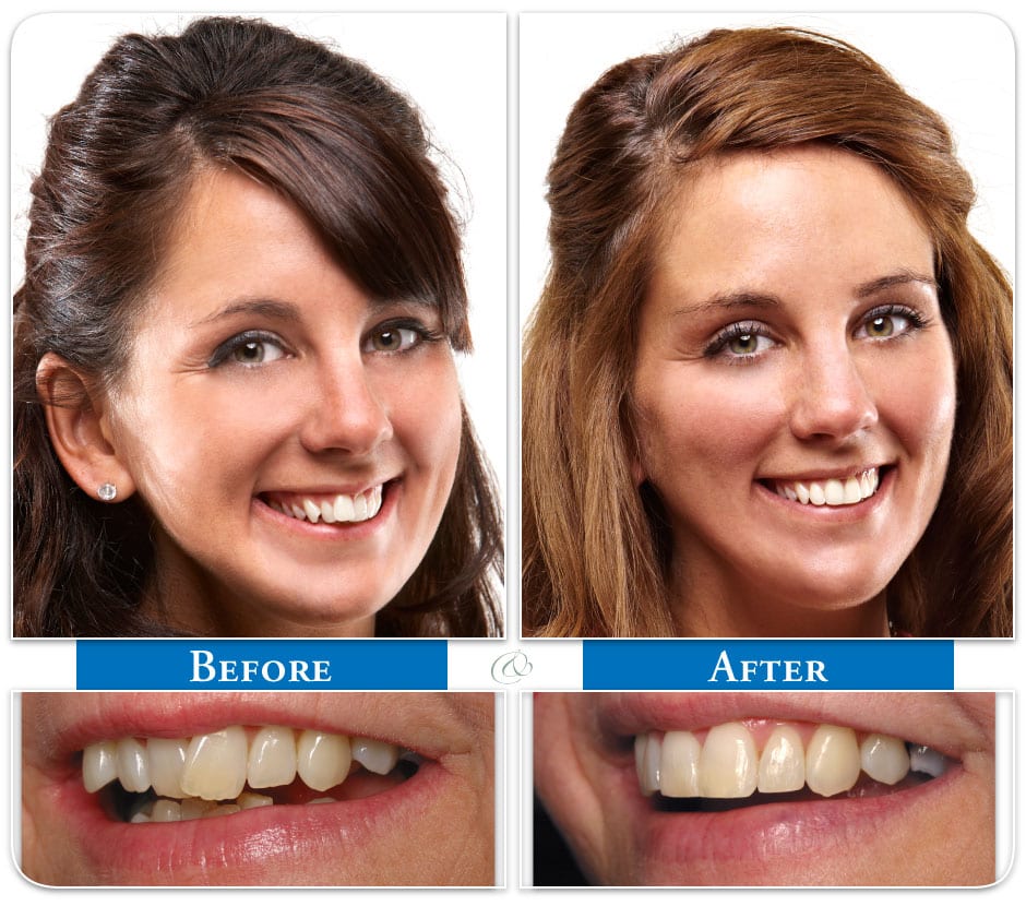 Six Month Smiles Before And After - Guerradental.com