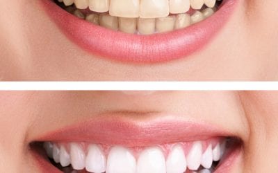 Everything You Need to Know about Teeth Whitening in Colorado Springs