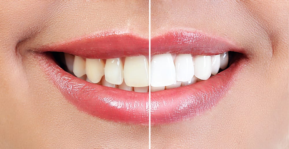 before and after teeth whitening smile